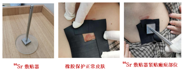 瘢痕疙瘩又丑、又癢、又痛怎么辦?它的&ldquo;克星&rdquo;來(lái)了